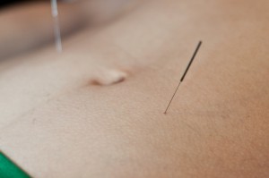 Acupuntura e auriculoterapia em contagem